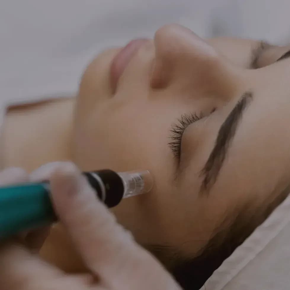 A microneedling pen being drawn across the skin