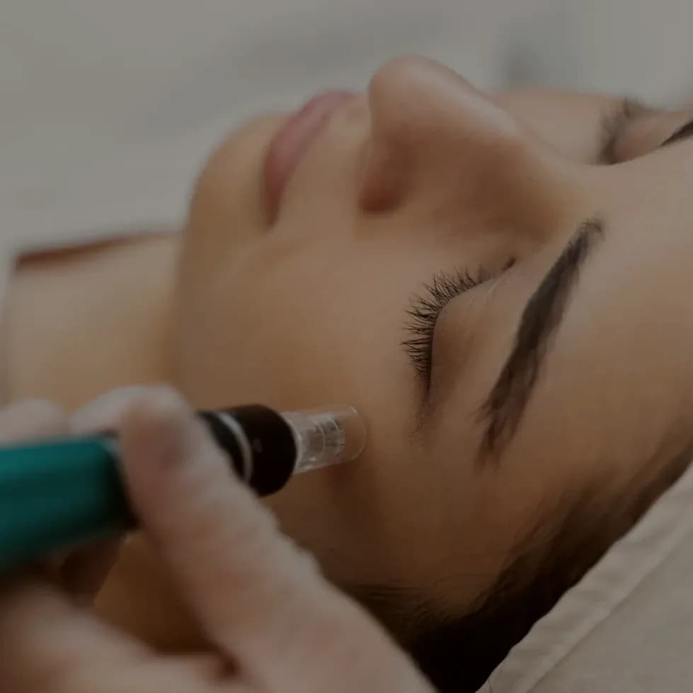 A microneedling pen being drawn across the skin